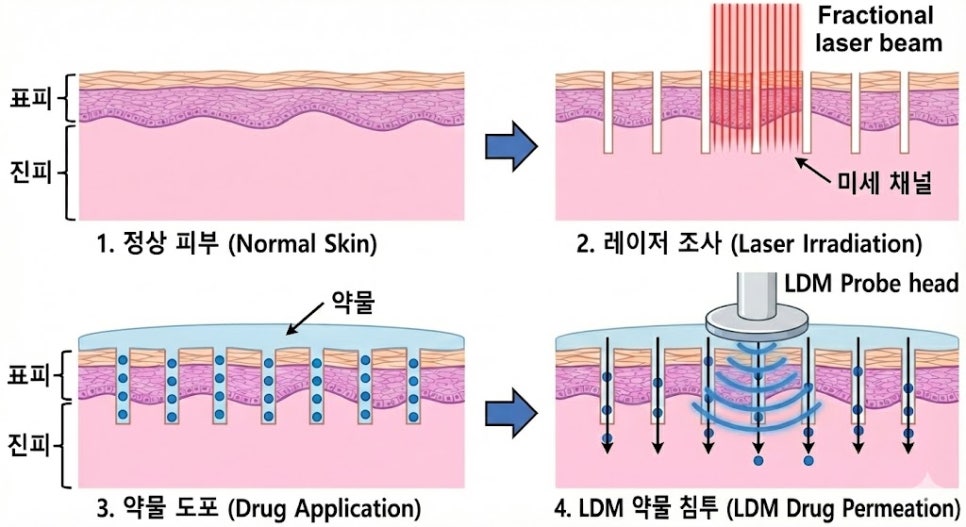 LADD 시술 원리